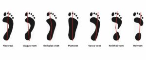 voettypes sengers podotherapie wijchen