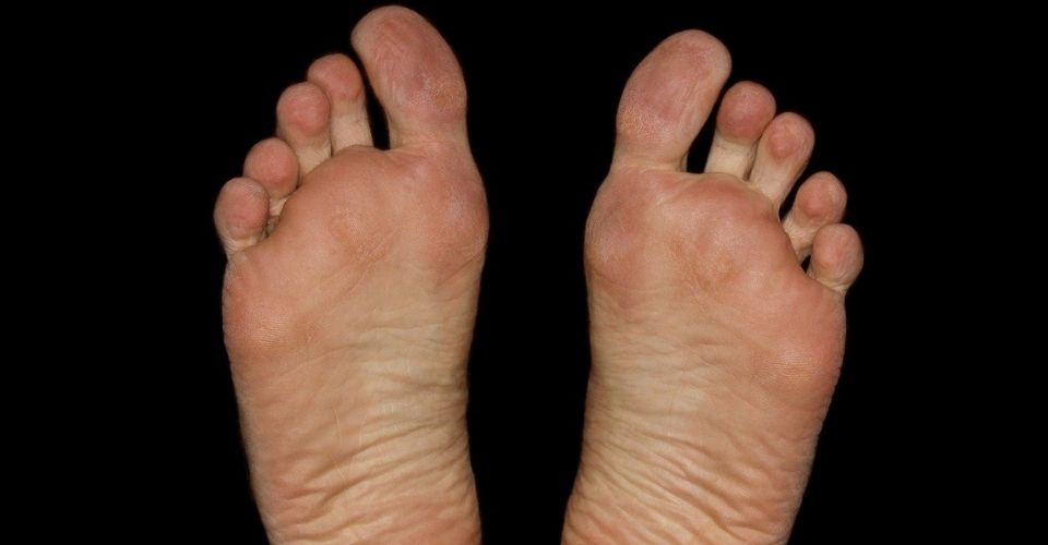 Bobbeltjes onder de voet, ziekte van Ledderhose