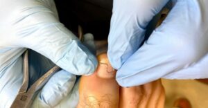 nagelbeugel ingegroeide nagel sengers podotherapie wijchen