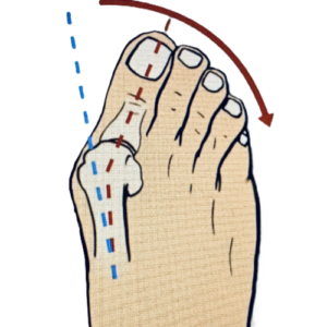 Hallux valgus