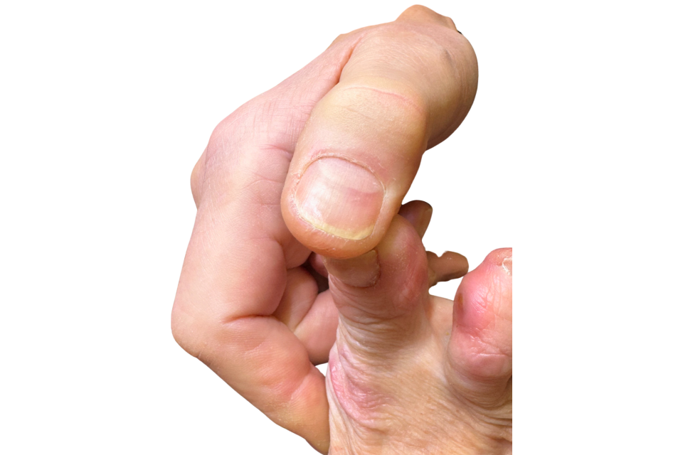 instrumentele behandeling (960 x 640 px) (1) Instrumentele behandeling podotherapie Wijchen